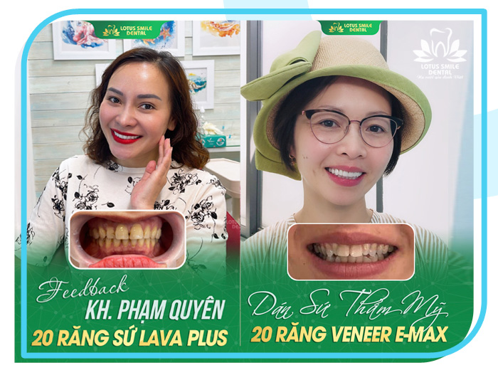 Răng sứ 15 Lotus-dental-hinh-anh-kh-10
