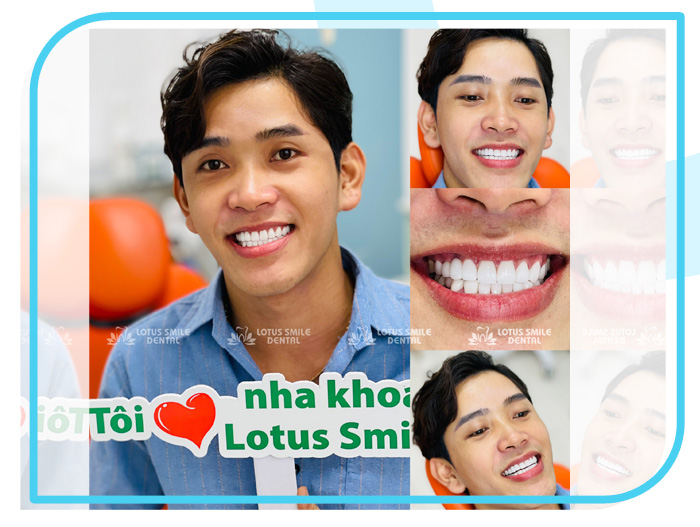 Răng sứ 17 Lotus-dental-hinh-anh-kh-13