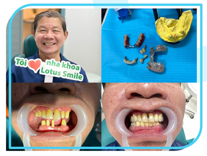 Răng sứ 10 Lotus-dental-hinh-anh-kh-14