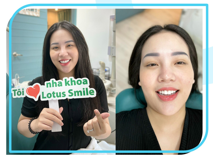 Răng sứ 19 Lotus-dental-hinh-anh-kh-15