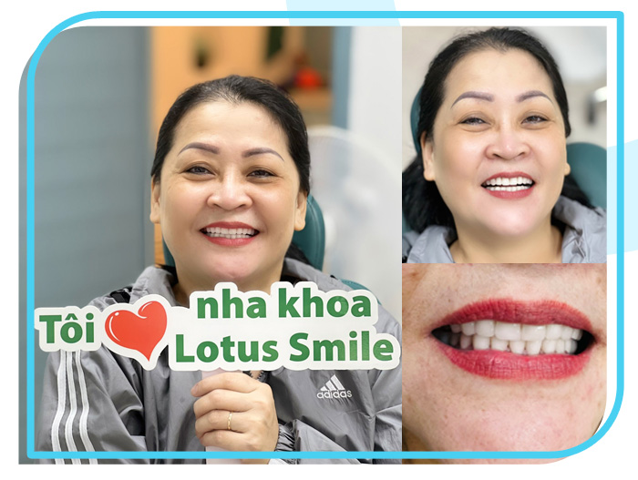 Răng sứ 08 Lotus-dental-hinh-anh-kh-2-1