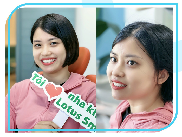 Răng sứ 20 Lotus-dental-hinh-anh-kh-3-1
