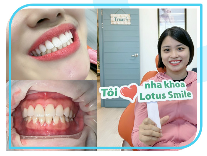 Lotus-dental-hinh-anh-kh-3