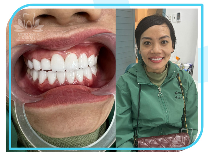 Răng sứ 13 Lotus-dental-hinh-anh-kh-7