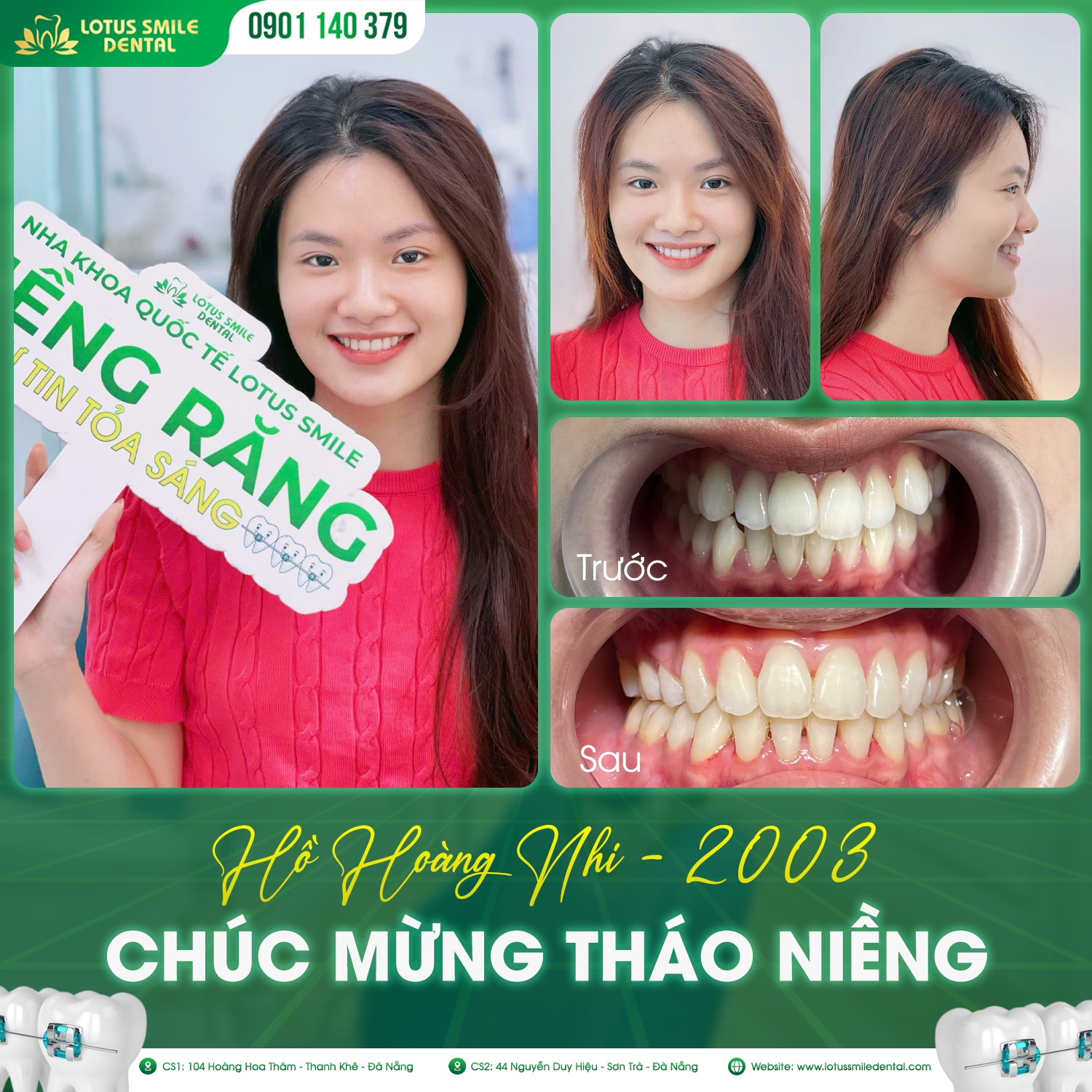 niềngrăng-Lotussmile