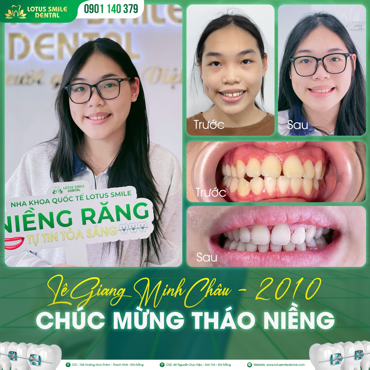 niềngrăng-Lotussmile2