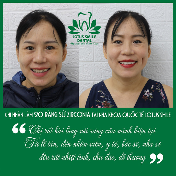 Chị Nhàn - BỌC 20 RĂNG TOÀN SỨ 𝐙𝐈𝐑𝐂𝐎𝐍𝐈𝐀  kh1
