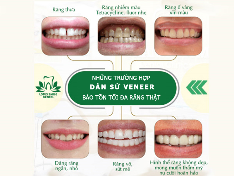 dan-su-veneer-4