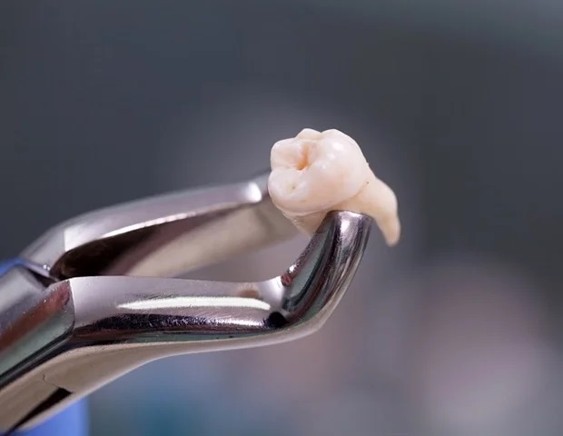 NHỔ RĂNG EXTRACTION
