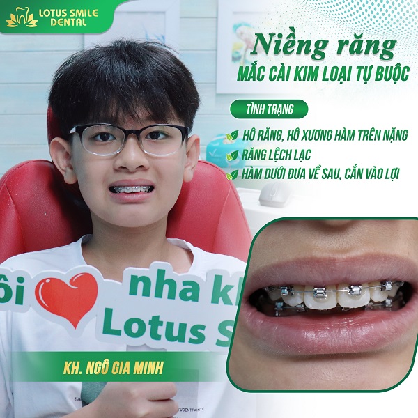 Niềng răng 04 gia-minh
