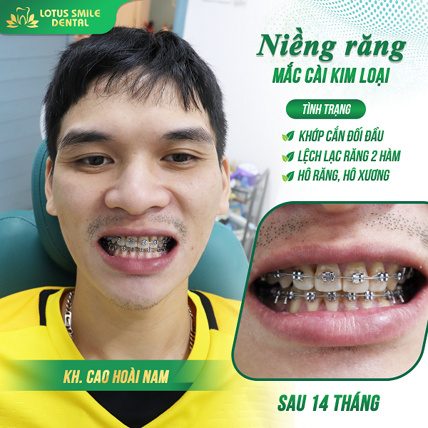 Niềng răng 05 hoai-nam