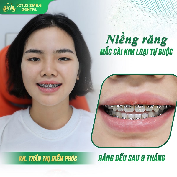 Niềng răng 06 kh-diem-phuc