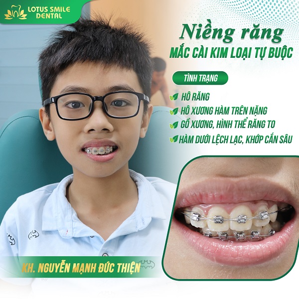 Niềng răng 07 kh-duc-thien