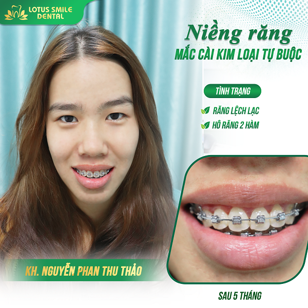 Niềng răng 08 kh-thu-thao