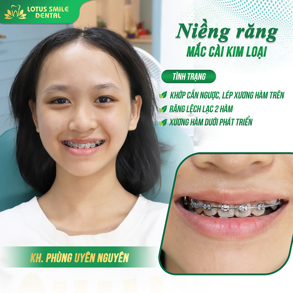 Niềng răng 09 kh-uyen-nguyen