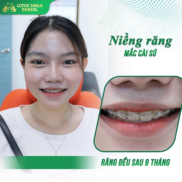 Niềng răng 10 nieng-rang-kh