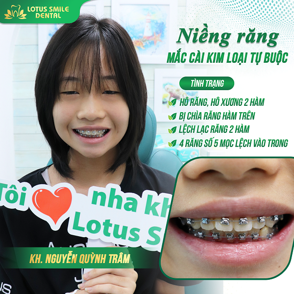 Niềng răng 11 quynh-tram