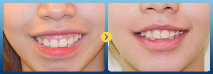 Điều trị cười hở lợi bằng cách nào an toàn, không tái phát? 02-8