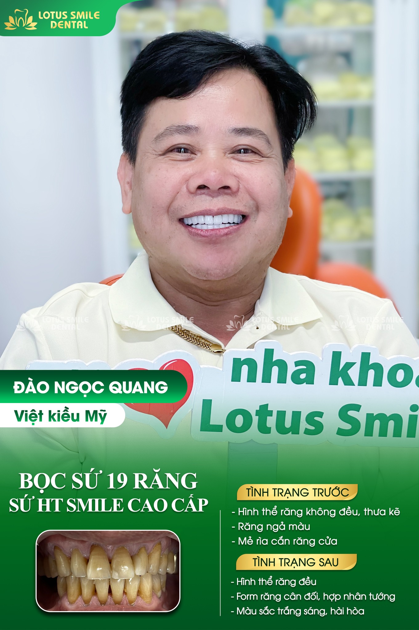 Chú Đào Ngọc Quang (Việt kiều Mỹ) vừa hoàn thiện 19 răng sứ HT Smile cao cấp tại Nha khoa Lotus Smile 360124371_659784599504175_3369785633095678001_n