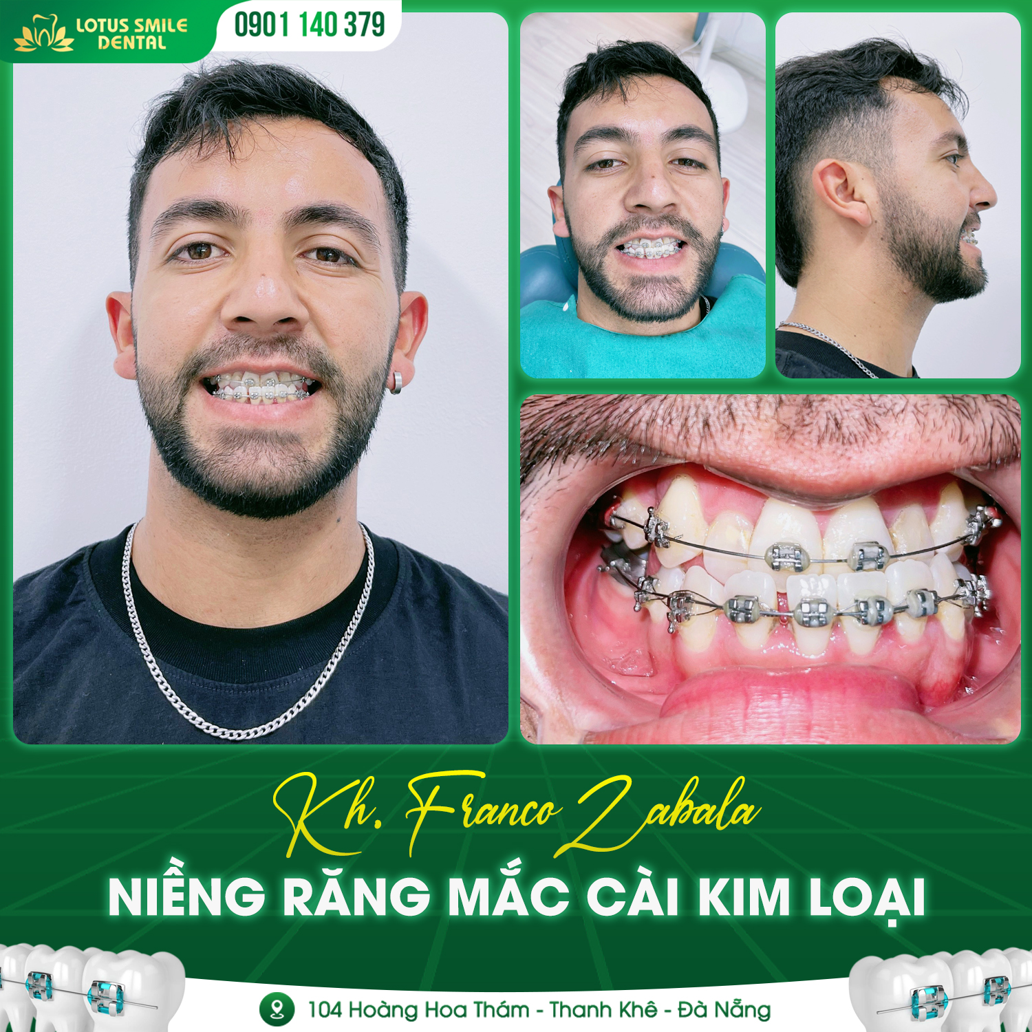 Chào mừng anh Franco Zabala về với team niềng răng Lotus Smile Dental 362943782_240463678830627_1680884228234832052_n
