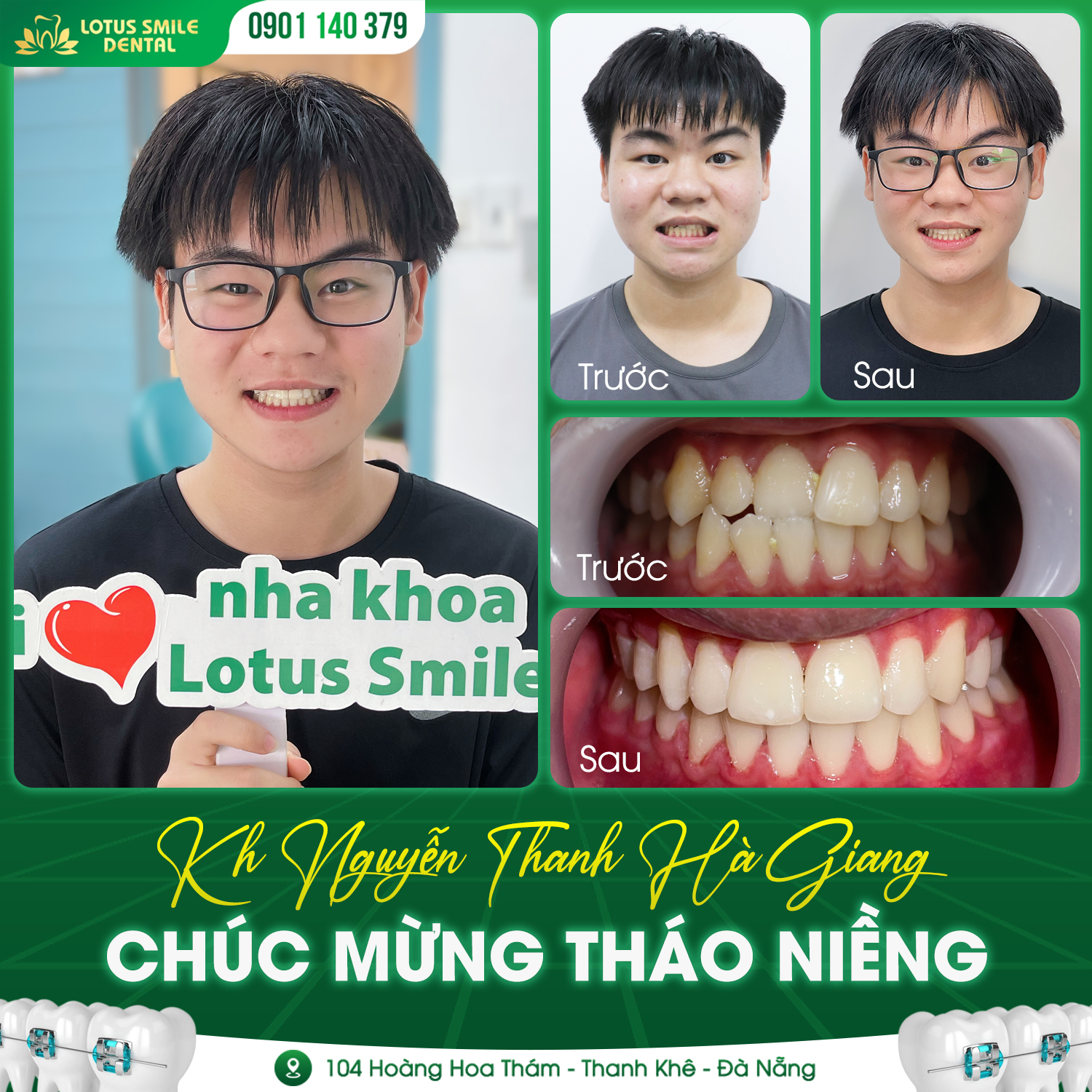 Hà Giang thay đổi như thế nào sau khi tháo niềng răng 382232123_698262682323033_4636692779400468864_n