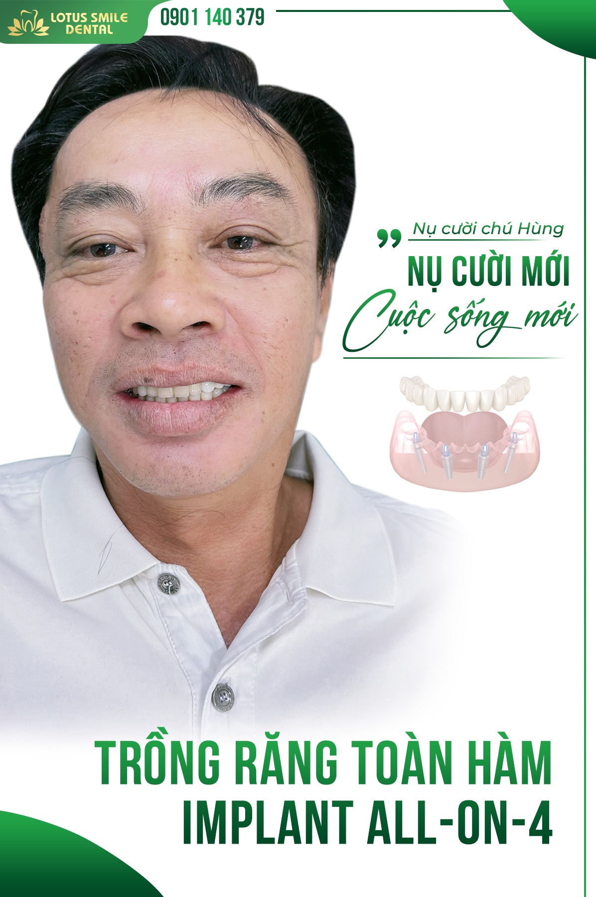 Nụ cười chú Mạnh Hùng sau khi sử dụng combo kết hợp Trồng răng Implant toàn hàm All-on-4 và Bọc răng sứ tại Nha khoa Lotus Smile 387809221_283940707816257_974803738781343408_n