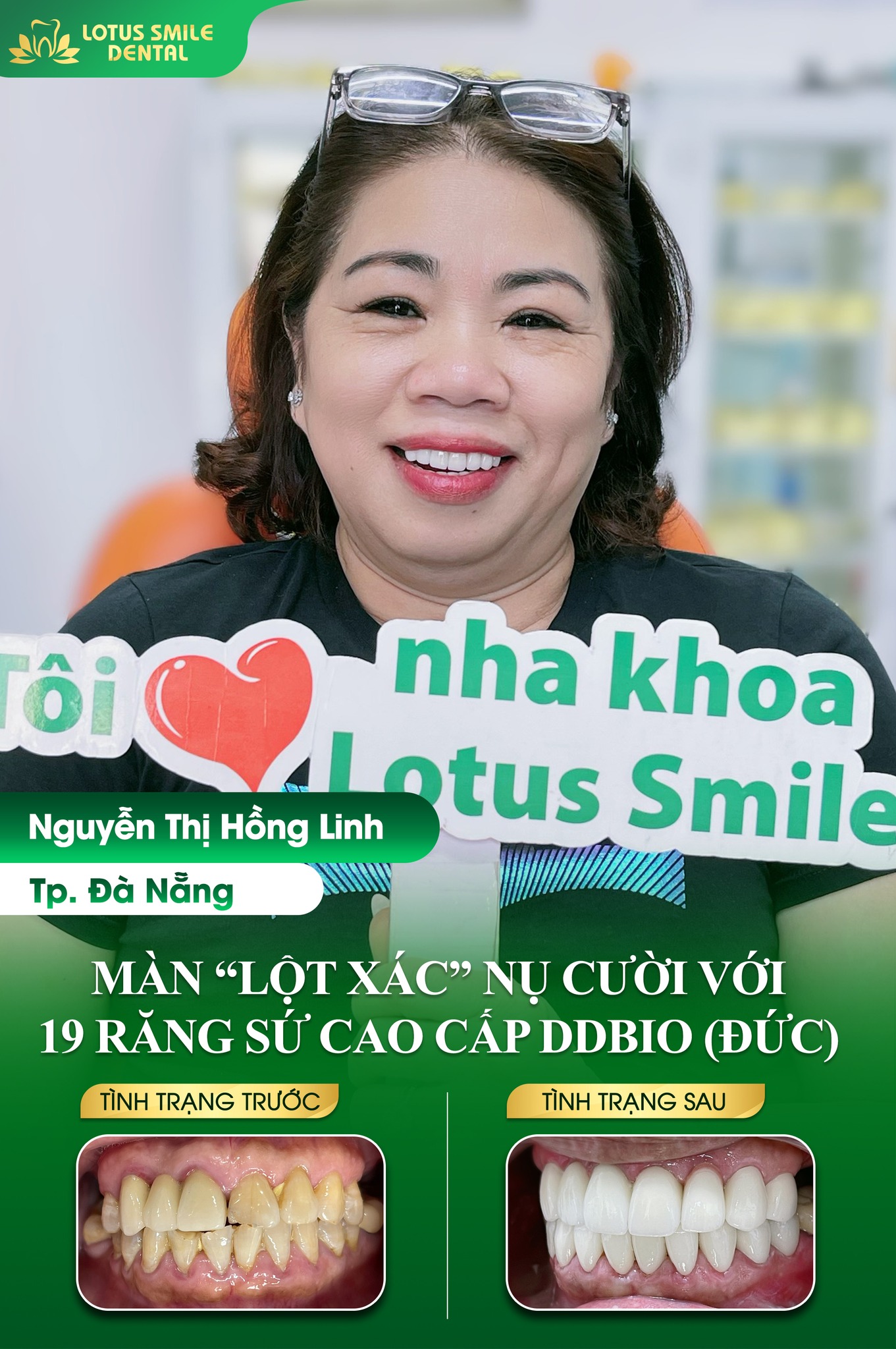 Bọc Răng Sứ- Đầu Tư Cho Nụ Cười Tự Tin 433037223_802147858601181_947253592456747280_n