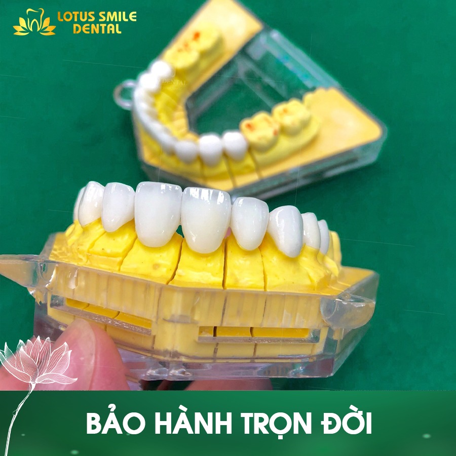 Tìm hiểu về bọc răng sứ nguyên hàm – Giải pháp cho hàm răng hoàn hảo 291352681_584227570083017_2673195443151641481_n