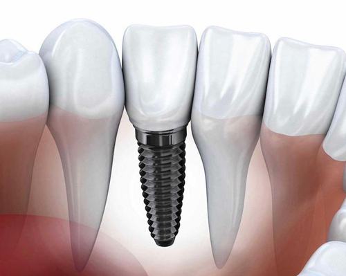 Cảnh Báo – Hậu Quả Của Cấy Ghép Implant Giá Rẻ hau-qua-cua-trong-implant-gia-re