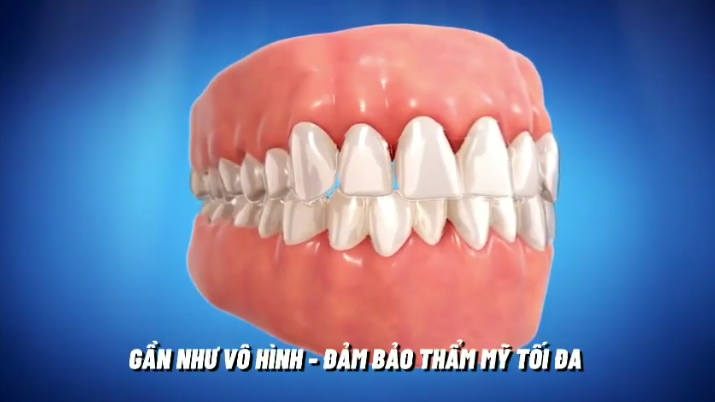 Quá trình lấy dấu ban đầu cho khách hàng L.C.N.L 17 tuổi để thiết kế máng chỉnh nha trong suốt - Invisalign tại Lotus Smile Dental lay-dau-INVISALIGN-lotus