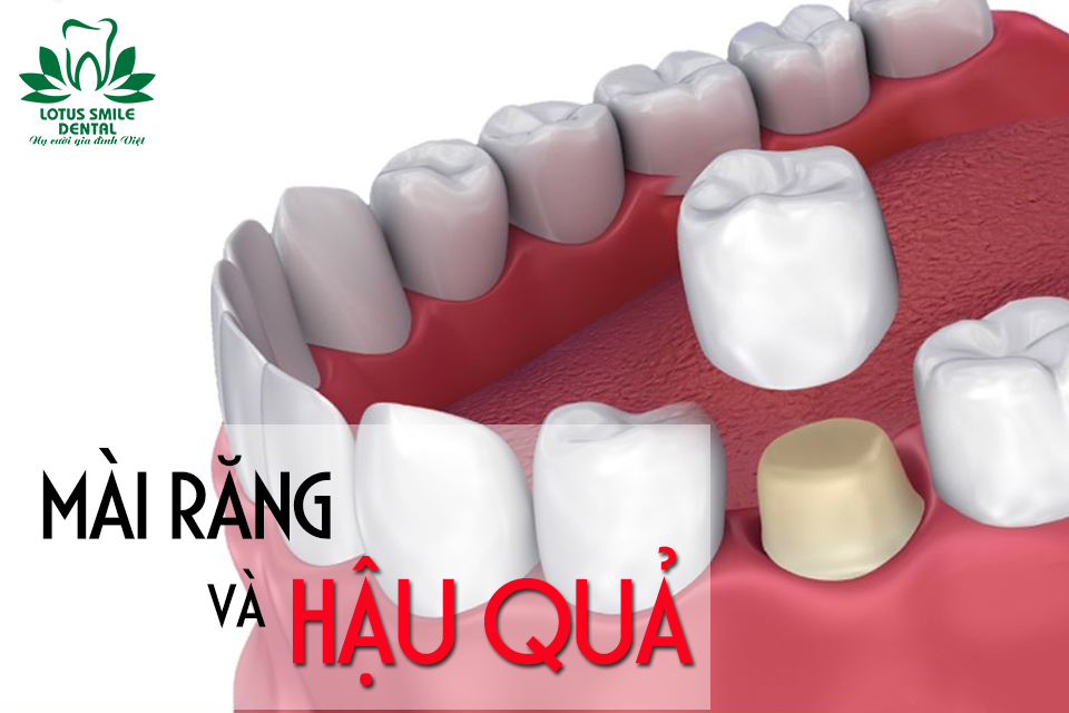 MÀI RĂNG QUÁ NHỎ - HẬU QUẢ NGHIÊM TRỌNG mai-rang-va-hau-qua