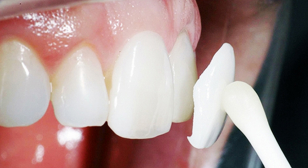 Địa chỉ bọc răng sứ Veneer tốt ở Đà Nẵng dan-rang-su-veneer-co-tac-hai-gi-khongpng-3
