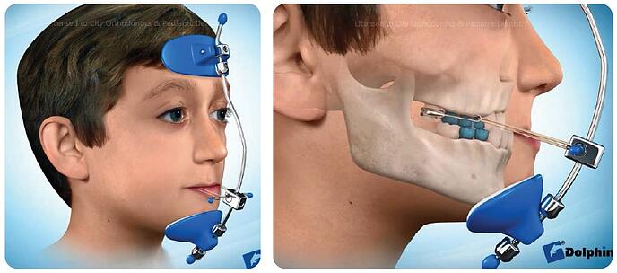 Facemask chỉnh nha – Khí cụ hỗ trợ điều trị khớp cắn ngược cho trẻ Facemask