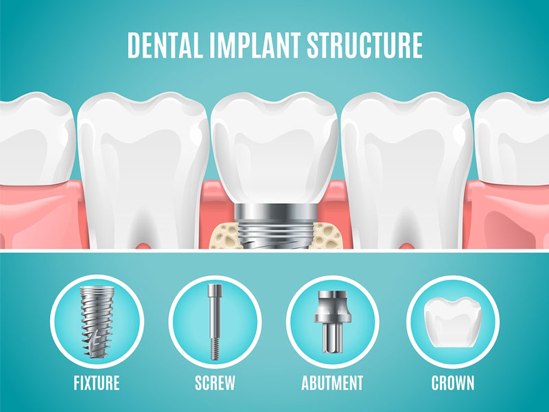 Nhược điểm của trồng răng implant và một số lưu ý bạn cần biết rang-implant-gom-nhung-phan-nao