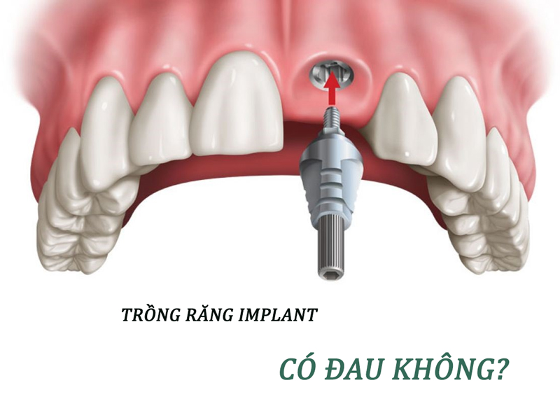 Trồng răng Implant có đau không? Mất bao lâu để hồi phục trong-rang-implant-co-dau-khong-1