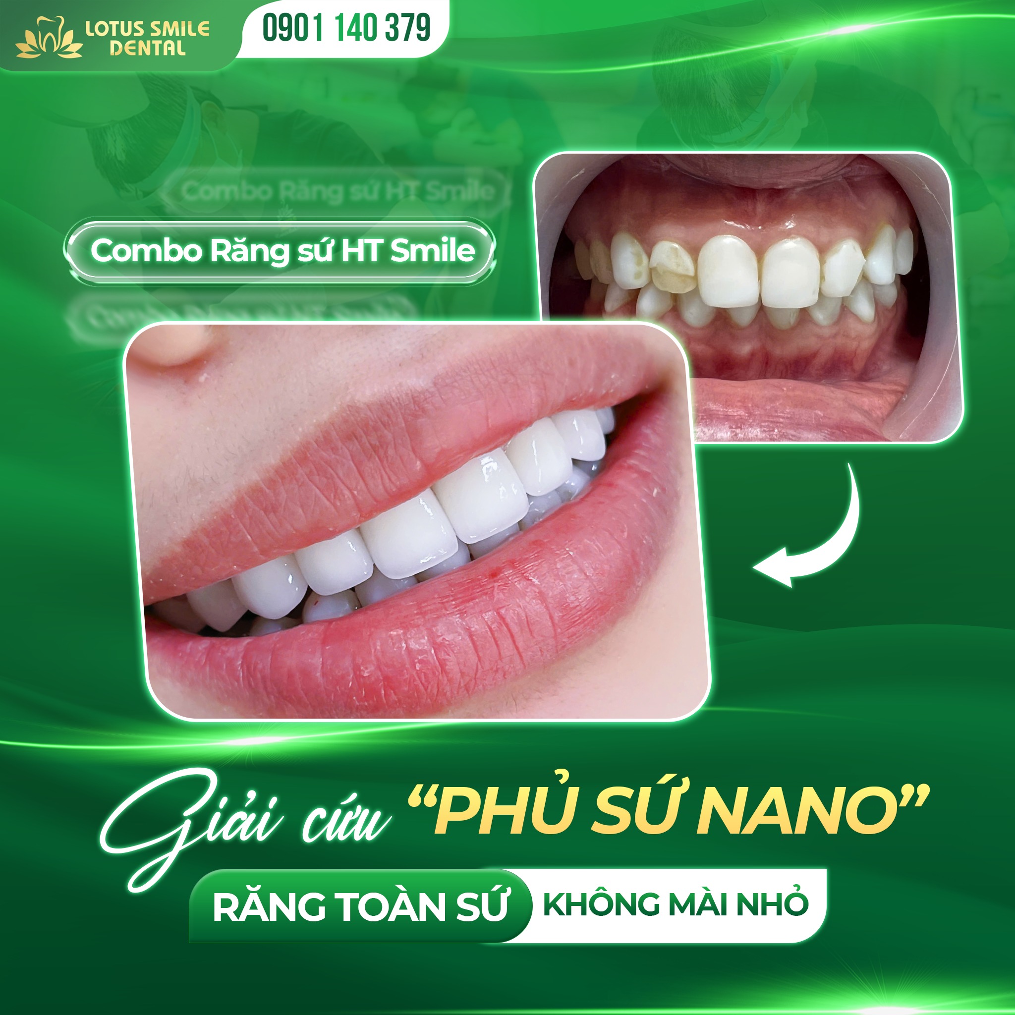 bọcrăngsứ(1)