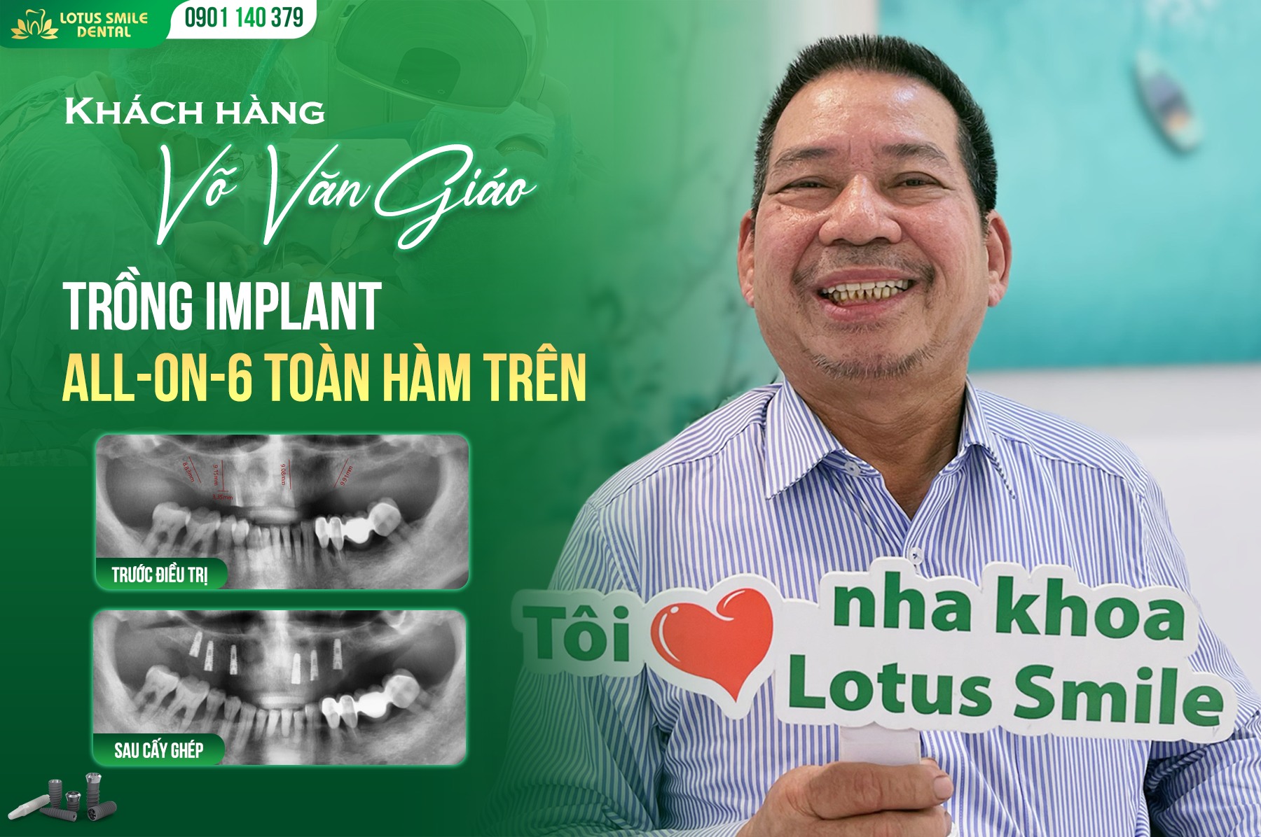 Khắc Phục Răng Xỉn Màu, Mẻ Vỡ Với Công Nghệ Bọc Sứ Hiện Đại TRỒNGRĂNGIMPLANTTOÀNHÀM