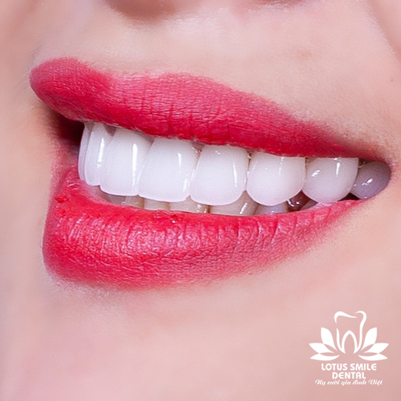 Cắm Trụ Răng Implant – Công Nghệ Tiêu Chuẩn Quốc Tế kh2