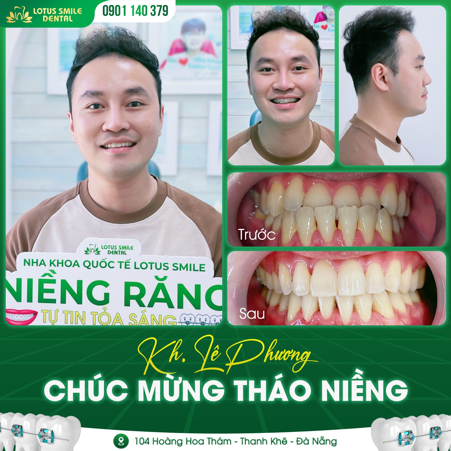 Niềng Răng Mắc Cài Ở Đà Nẵng Tại Nha Khoa Lotus Smile niềngnam