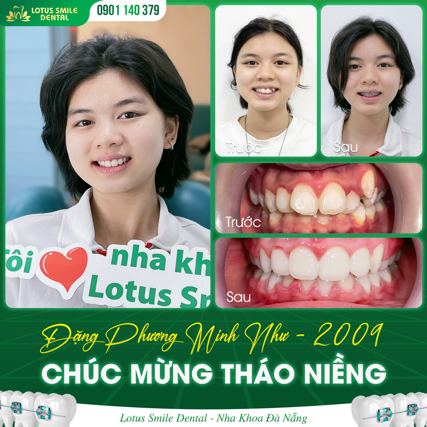 Lợi Ích Khi Niềng Răng Sớm Cho Trẻ  Niềngrăngthànhcông1