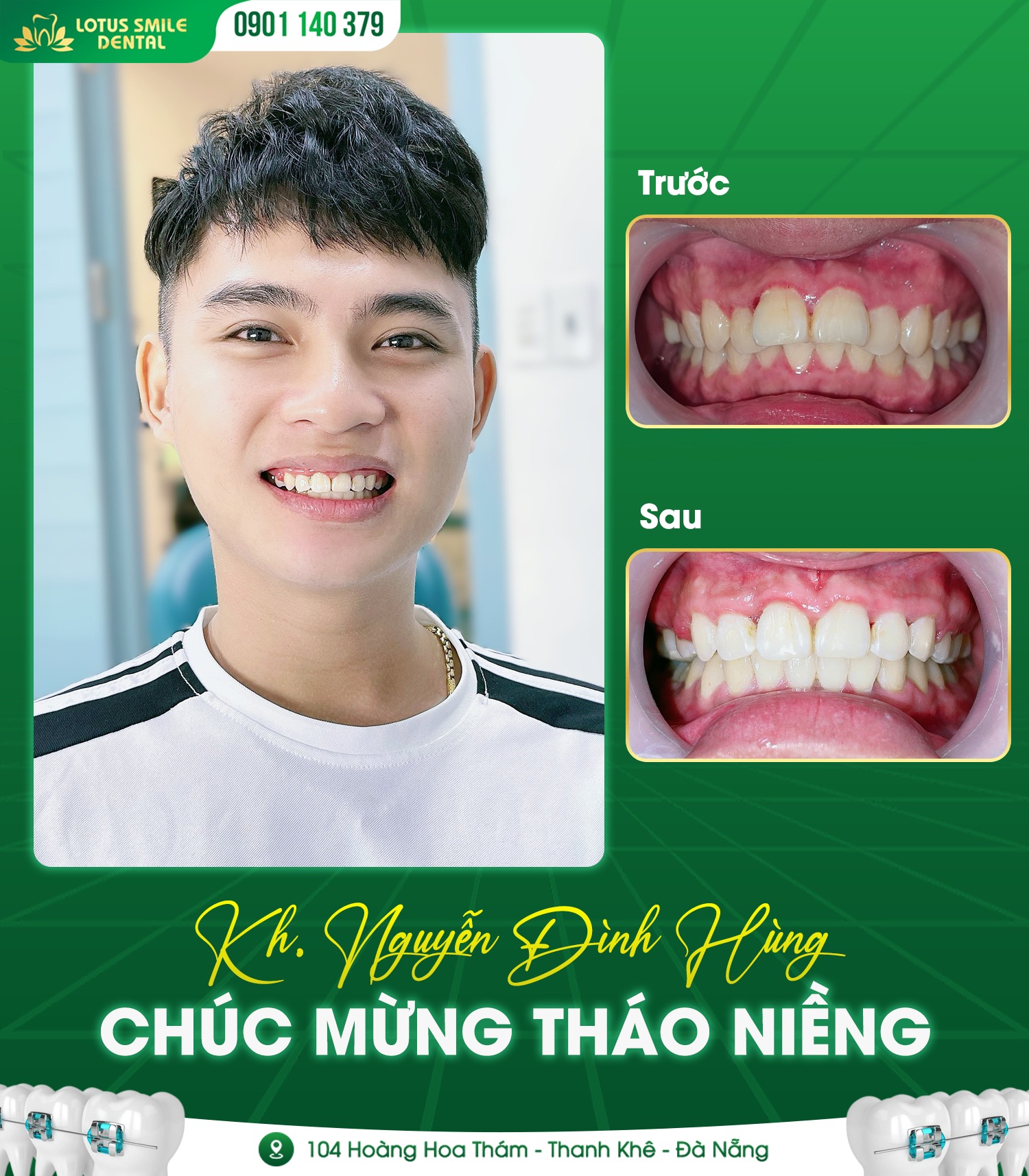How beautiful are braces? Niềngrăngthànhcông2