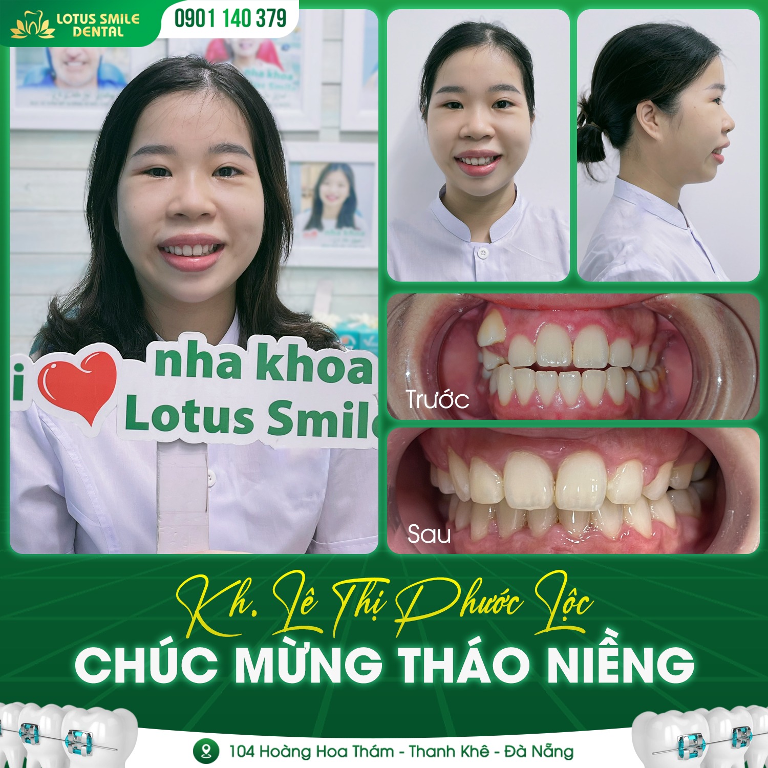 Niềng Răng Cho Học Sinh - Sớm Can Thiệp, Hiệu Quả Cao Niềngrăngthànhcông4