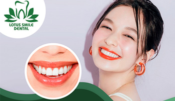 Porcelain VENEER in Da Nang boc-rang-su-lotus-smile-dental-1