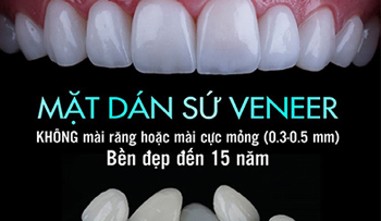 dan-su-veneer-tai-lotus-smile-dental