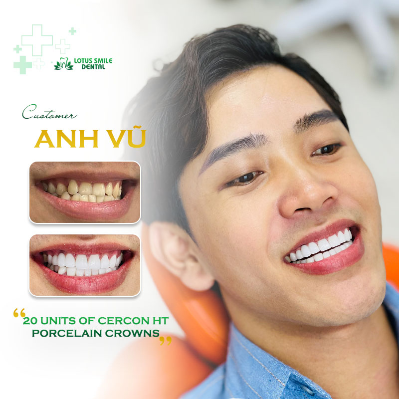 Bí Quyết Giữ Răng Sứ Bền Đẹp Lâu Dài - Từ Chăm Sóc Đúng Cách Mỗi Ngày Khach-hang-lt-TA-3