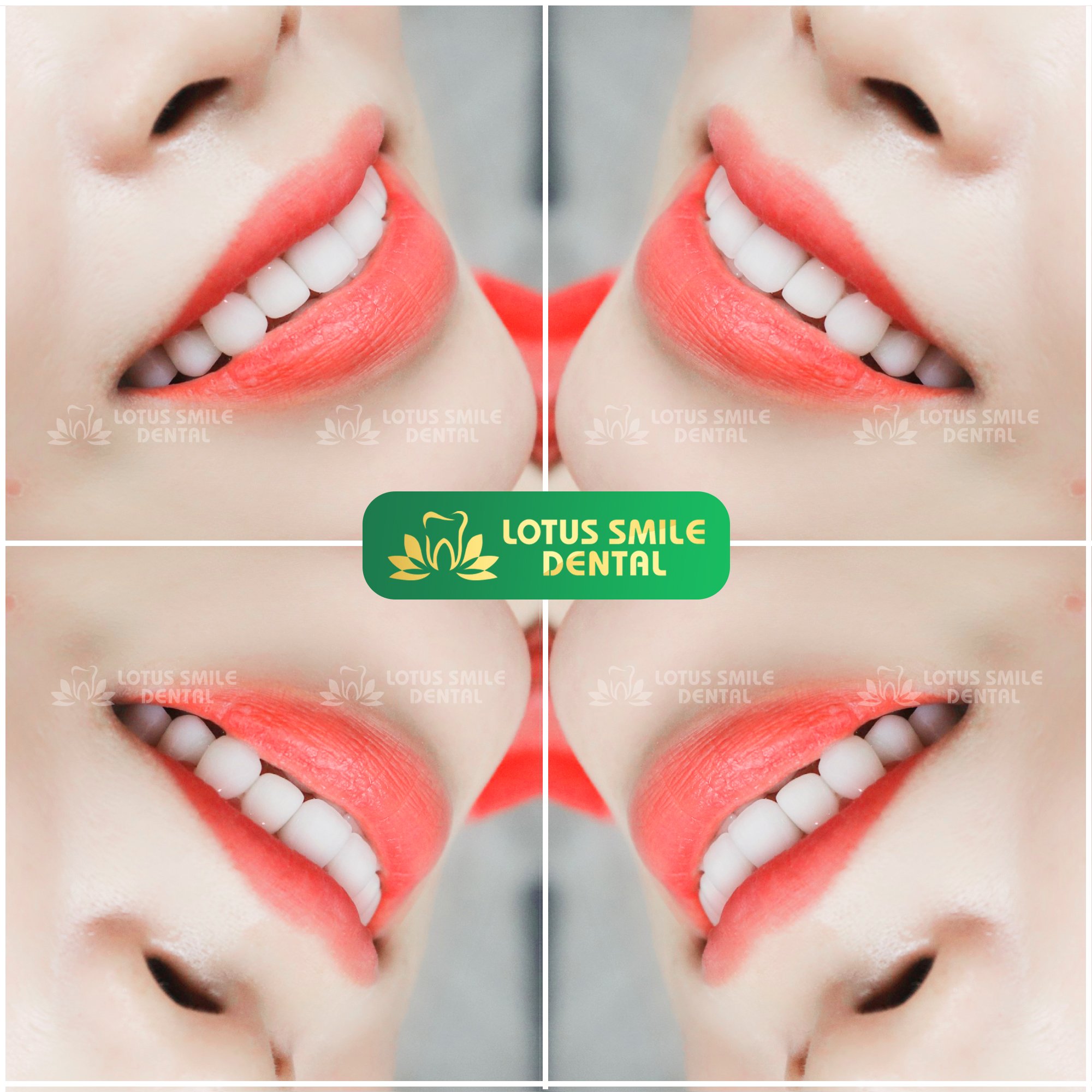 Quy Trình Bọc Răng Sứ Thẩm Mỹ  Tại Nha Khoa Lotus Smile 286088876_565117538660687_4543875486888073345_n