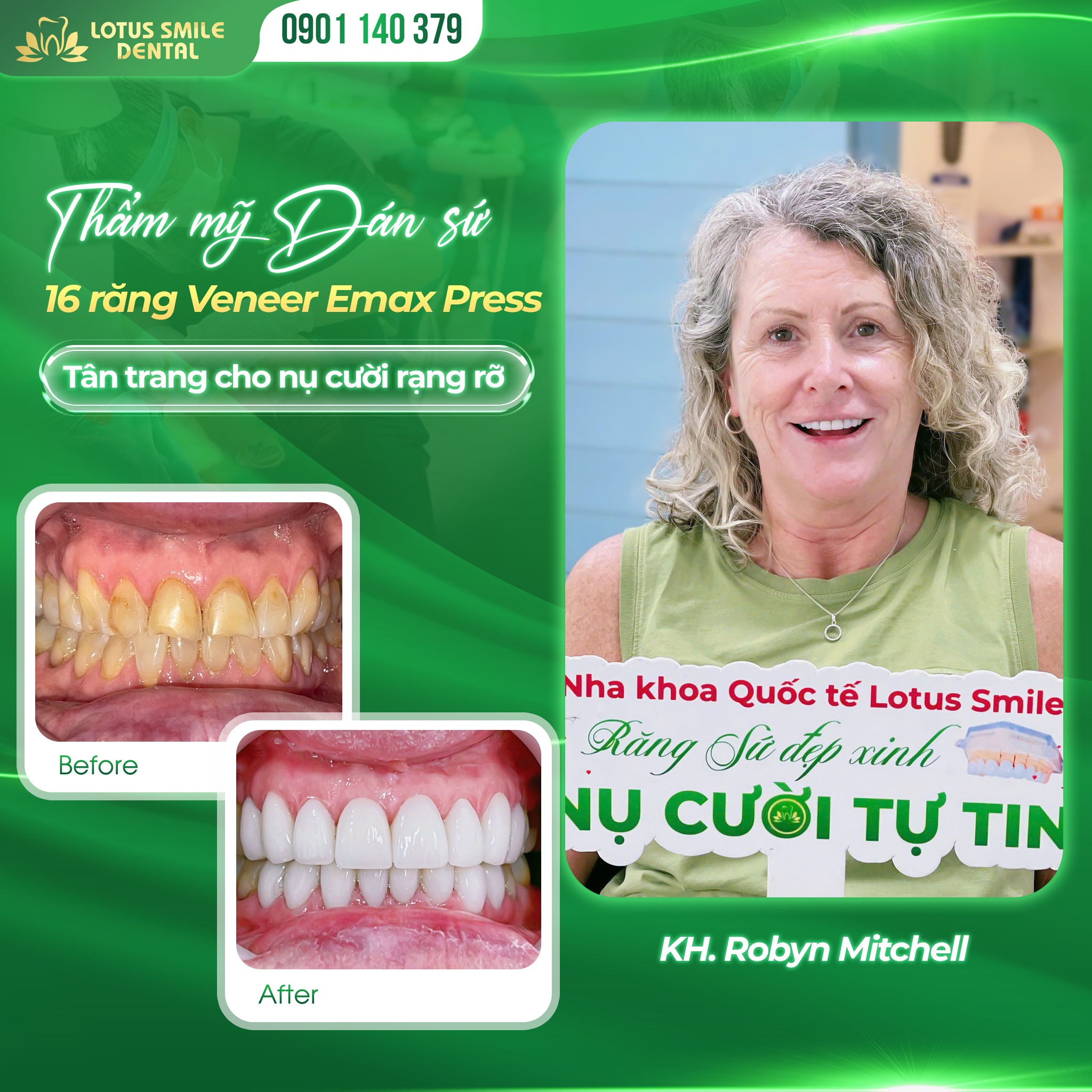 7 Criteria for Beautiful and Safe Porcelain Teeth 539035641_757521033805618_3077993993465421545_n