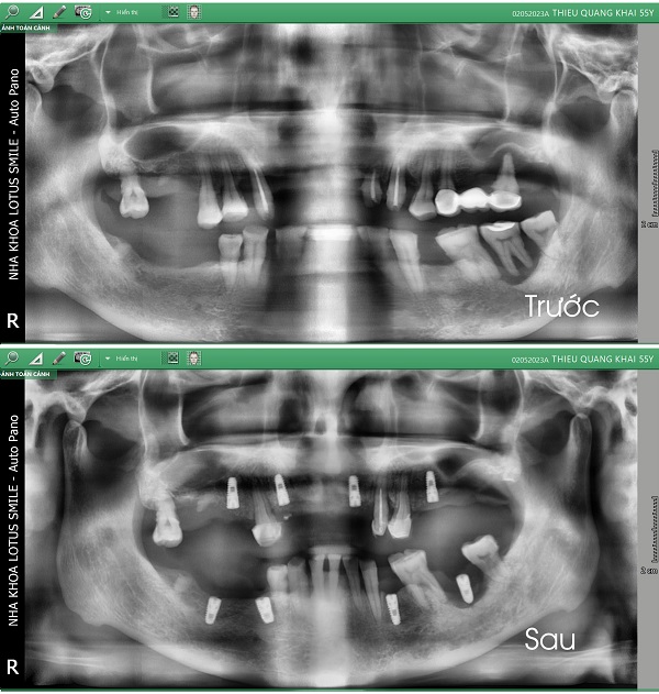 ct-chu-thieu-quang-khai