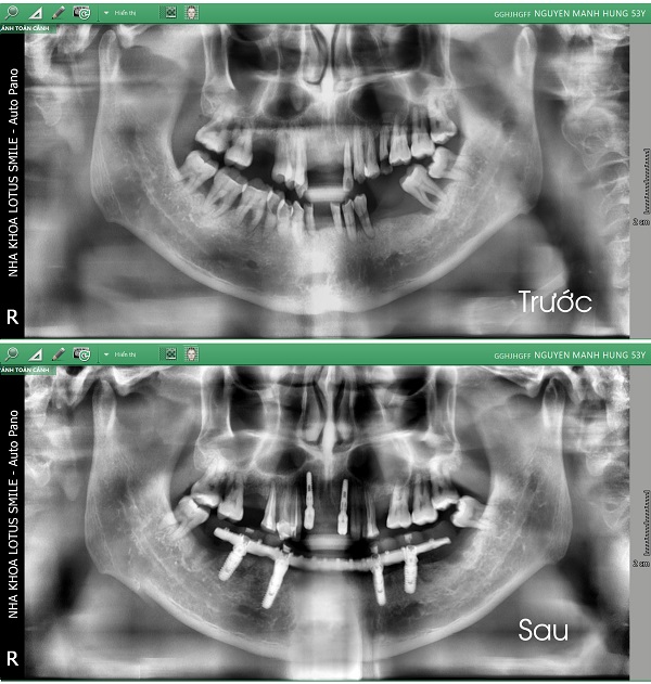 ct-chunguyenmanhhung