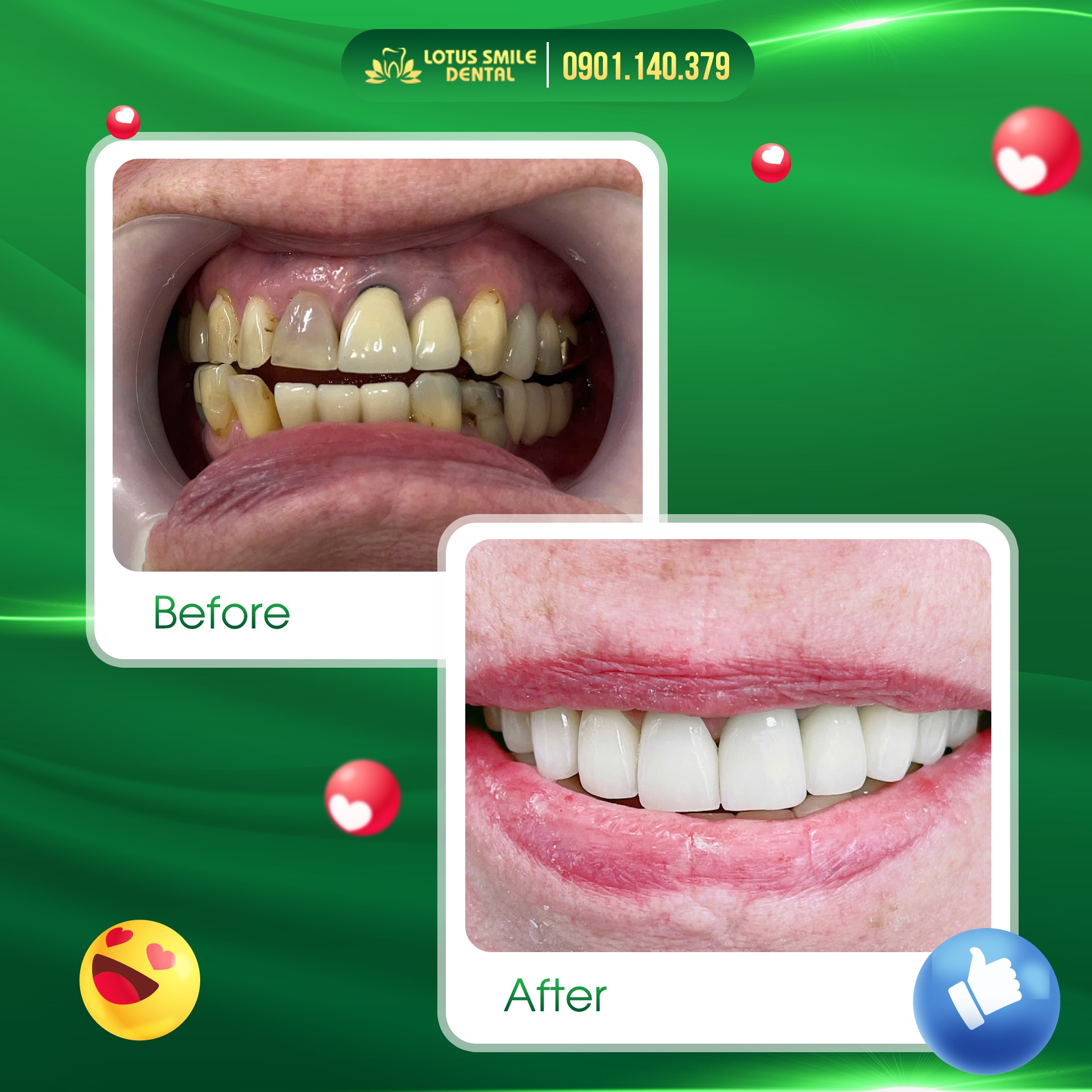 Bọc Răng Sứ Sau Bao Lâu Thì Ăn Được Tại Nha khoa Lotus Smile? 547195462_1275484347707913_2505896523248620448_n